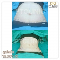 S__146972686.jpg - วันนี้เราจะมารีวิวดูดไขมัน #PTCLINIC ค้า | https://ptinfinity.com