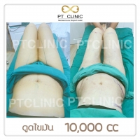 S__146972689.jpg - วันนี้เราจะมารีวิวดูดไขมัน #PTCLINIC ค้า | https://ptinfinity.com