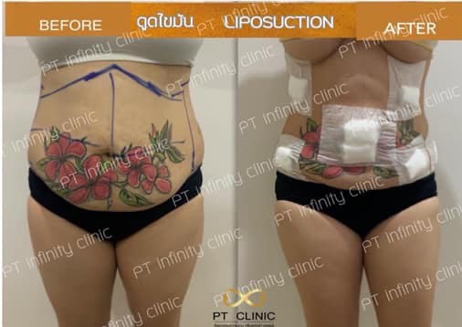 a3 - https://ptinfinity.com | PT CLINIC ศัลยกรรมความงาม ปรับรูปหน้า เลเซอร์