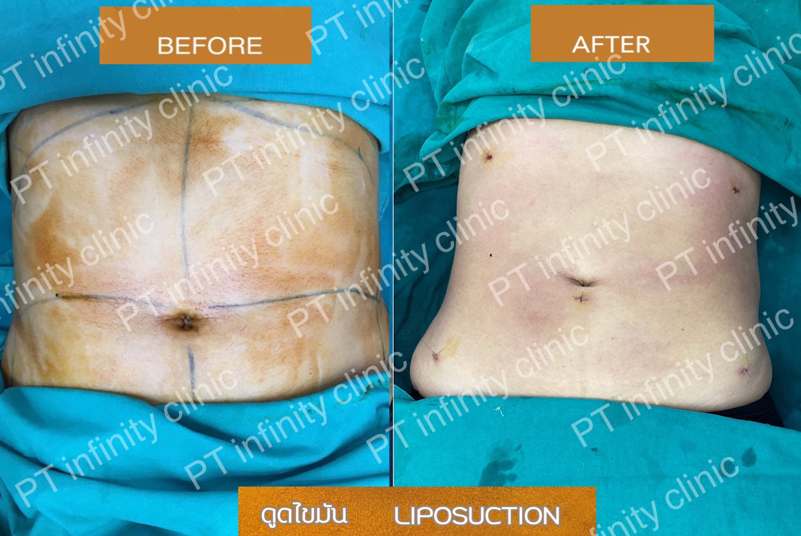 a4 - https://ptinfinity.com | PT CLINIC ศัลยกรรมความงาม ปรับรูปหน้า เลเซอร์