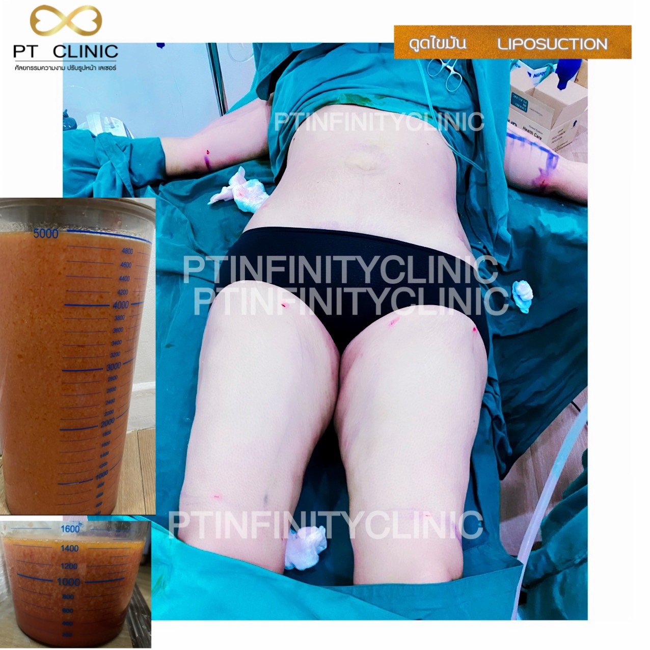 a7 - https://ptinfinity.com | PT CLINIC ศัลยกรรมความงาม ปรับรูปหน้า เลเซอร์