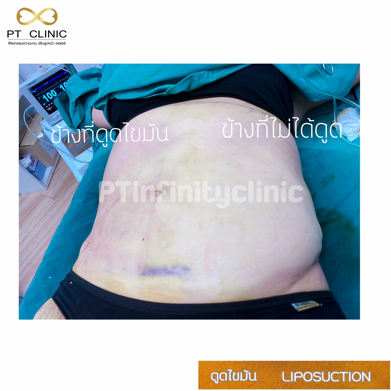 a8 - https://ptinfinity.com | PT CLINIC ศัลยกรรมความงาม ปรับรูปหน้า เลเซอร์