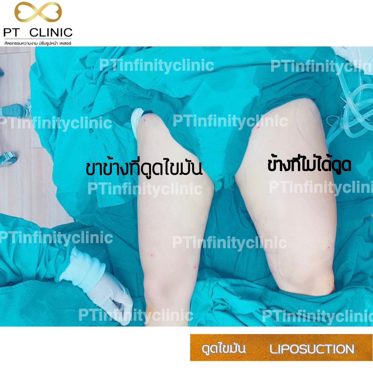 b1 - https://ptinfinity.com | PT CLINIC ศัลยกรรมความงาม ปรับรูปหน้า เลเซอร์