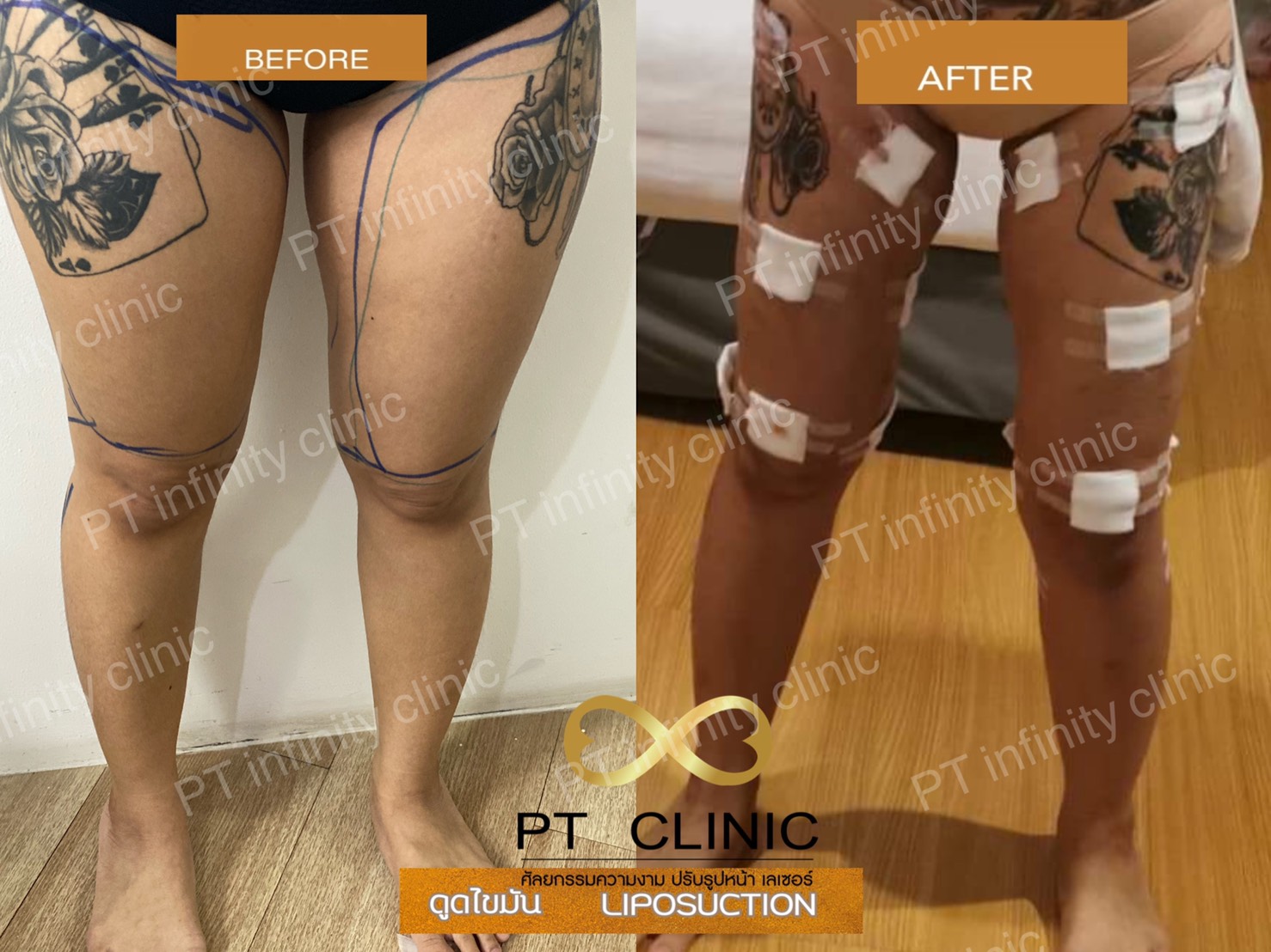 b3 - https://ptinfinity.com | PT CLINIC ศัลยกรรมความงาม ปรับรูปหน้า เลเซอร์