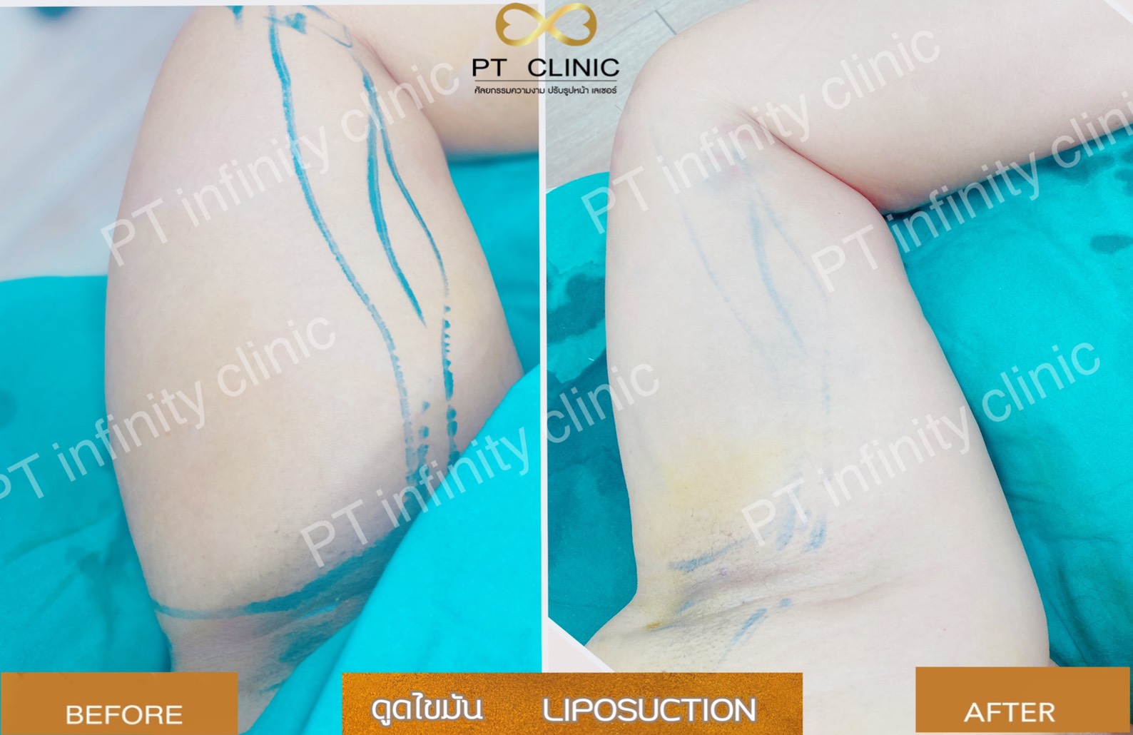 b5 - https://ptinfinity.com | PT CLINIC ศัลยกรรมความงาม ปรับรูปหน้า เลเซอร์